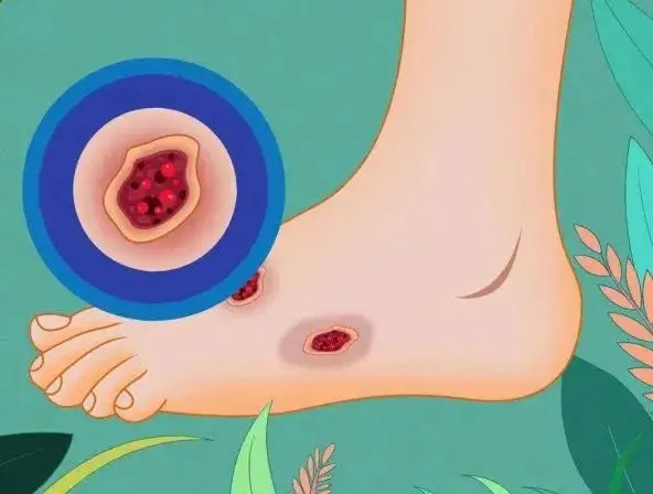 糖尿病足：无声的足部杀手