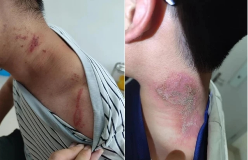 夏日“隐形杀手”出没！专家提醒：防隐翅虫皮炎，切记“两冲洗一就医”