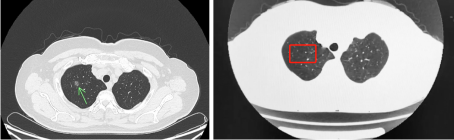 几副汤药，化解开胸之忧!——湖北省第三人民医院中医科运用中医药逆转1.1厘米肺结节